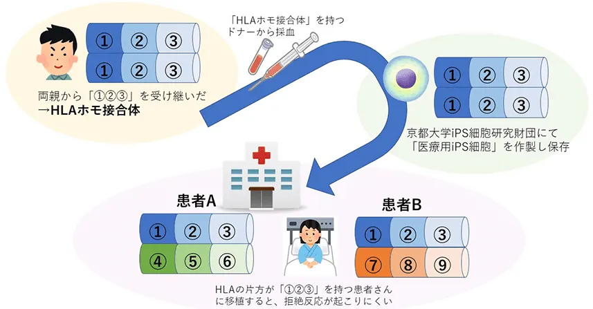 拒絶反応が起きにくい”HLA型の組み合わせ図